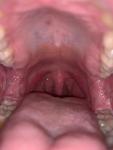 Симптомы сифилиса или вич фото 1