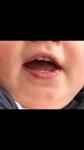 Шишка на губе у ребёнка фото 2