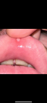 Что за нарост на слизистой верхней губы? фото 1