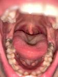 Ощущение инородного тела в левой части горла. Опасаюсь рака! фото 1