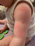 Аллергия у ребёнка в виде красных полос фото 4