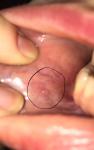 Единичные мелкие пузырьки во рту фото 1