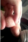 Шелушение на коже большого пальца фото 1