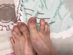Пупырышки на больших пальцах ног около ногтей фото 2