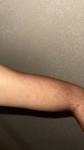 Появились красные пятна на руке, аллергия или заболевание органов? фото 1