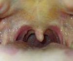 Воспаление горла, образование наростов на горле и языке фото 1