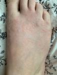 Аллергия на ступнях фото 2