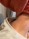 Сыпь на шее, аллергия фото 2