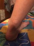 Тромб на ноге после операции фото 2