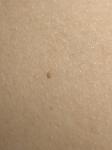 Появляются мелкие коричневые точки на теле фото 2