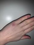 Красное пятно на костяшке руки фото 3