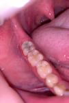 Припухлость возле зуба на десне фото 3