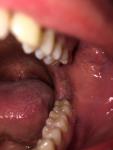 Белые образования слизистой на месте зуба фото 2