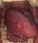 Лейкоплакия полости рта фото 3