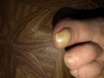 Изменение формы ногтя большого пальца ноги фото 1
