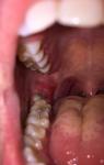 Воспаление капюшона (дёсны) над зубом мудрости фото 1