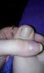 Темное пятно на ногте у ребенка фото 2