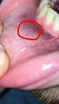 Уплотнённое образование на слизистой нижней губы фото 1