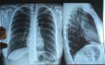 Описание рентгенографии органов грудной клетки фото 1
