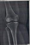 Постоянная боль в области левого колена фото 1
