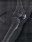 Постоянная боль в области левого колена фото 2