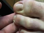 Коричневое пятно на большом пальце ноги фото 2