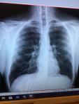 Рентген грудной клетки и легких фото 1