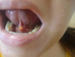 Воспаление под языком фото 3