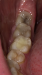 «Щелчки» в зубе и чувствительность после установки пломбы фото 1