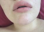 Мини-опухоли (шишки, прыщики) на губах после их увеличения фото 3