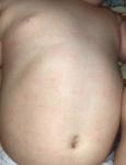 Сыпь у грудного ребёнка фото 2