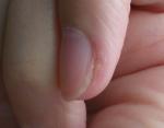 Грибок ногтя фото 1