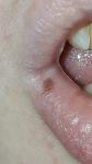 Пигментный невус на губе фото 2