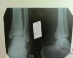 Перелом лодыжки, консультация ортопеда-травматолога фото 1
