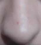 Красная точка на носу, не проходит 2 года фото 1