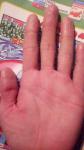 Сухость и шелушение кожи на пальца рук фото 2