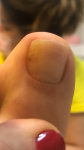 Пятно и желтизна на ногте фото 1