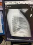 Пневмония или нет в сегменте s8 правое лёгкое фото 4