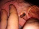 Болячка с гнойной коркой в ухе! фото 1
