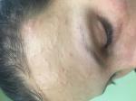 Сыпь на лице, или аллергия, или прыщи фото 1