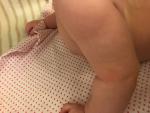Сухие розовые пятна на теле ребенка фото 2