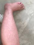 Белые пятна на ногах при беременности фото 1