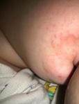 У ребёнка 8 месяцев образовалось пятно возле рта фото 1