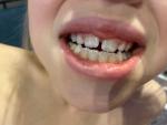 Пятна на коренных зубах ребёнка фото 1