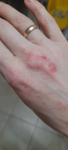 Мелкие, водянистые пузыри на коже рук, сильный зуд и раны фото 3