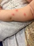 Прыщи похожие на комариные укусы у ребёнка фото 2