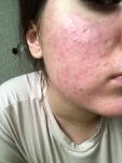 Аллергия, Сыпь на лице, аллергия, мб и прыщи, дерматит фото 1