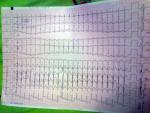 Учащенное сердцебиение, расшифровка ЭКГ фото 2