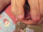 Трещины на ногтях больших пальцев фото 2