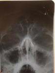 Рентген пневматизация не нарушена фото 2